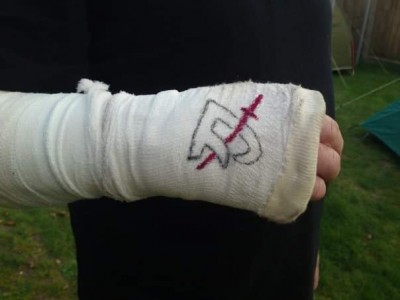 The aforementioned cast that he had set around a broom handle to make sure it fitted around his handlebars!!